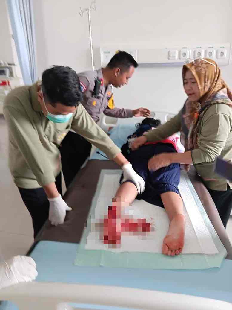 Pemudik Kakinya Terjepit Roda Motor, Begini Kondisinya Seorang Anak Kakinya Terjepit Roda Motor saat Mudik Lebaran sedang Menjalani Perawatan di Rumah Sakit
